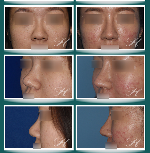 2023-09月份隆鼻鼻整形案例:自體肋骨鼻整形(鼻溝增高)、ePTFE(Gortex)鼻樑增高