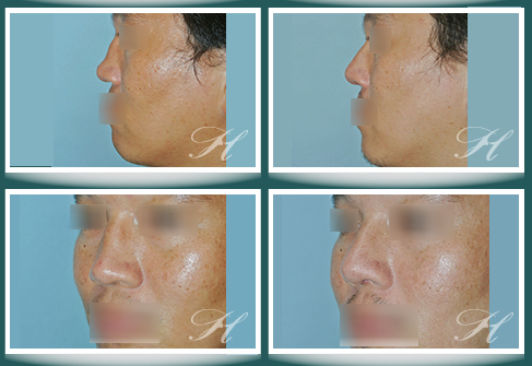 蕭彥彰醫師鼻整型 隆鼻 中心 醫學新知 鼻重建 塌陷鼻 馬鞍鼻 的矯正