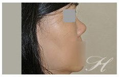 蕭彥彰醫師鼻整型(隆鼻)中心:: 獨創的設計家- 鼻部重建手術