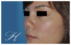 蕭彥彰醫師鼻整型(隆鼻)中心:: 獨創的設計家- 鼻部美容手術